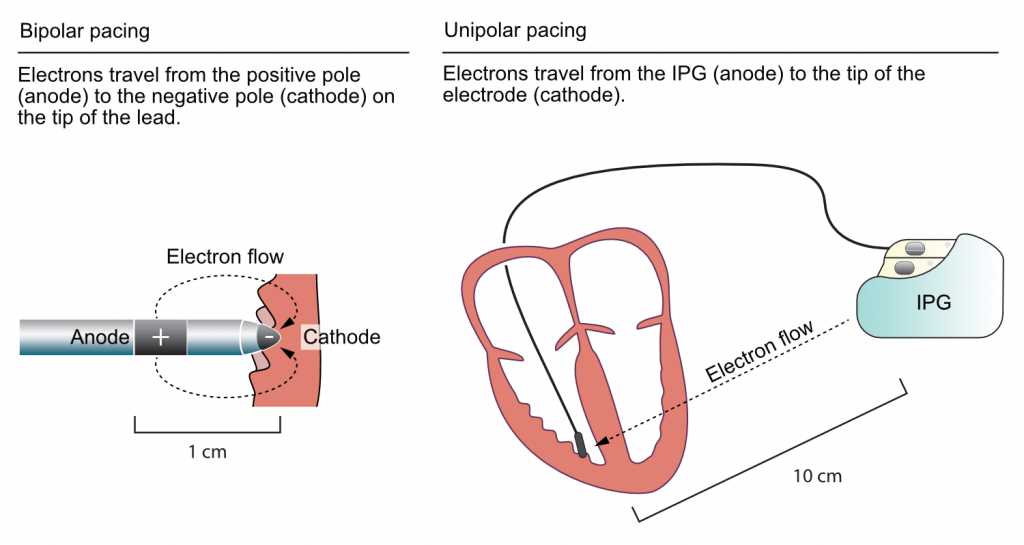 pacemaker circuit diagram