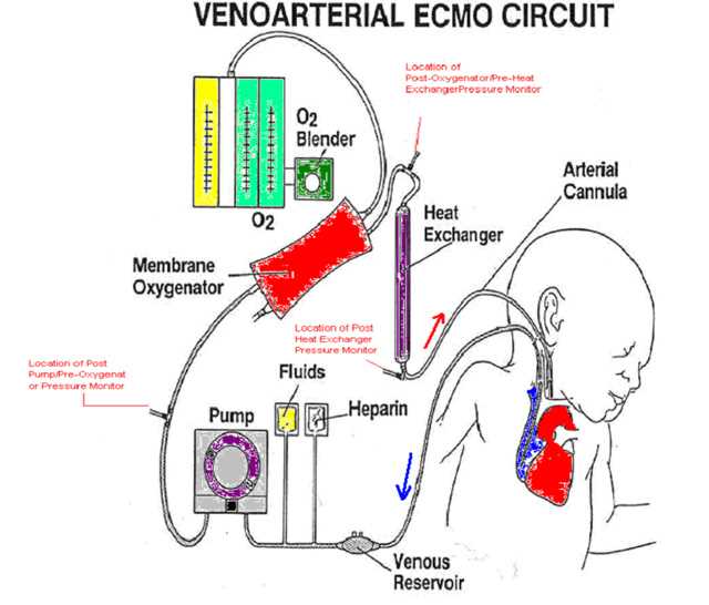 ecmo circuit diagram