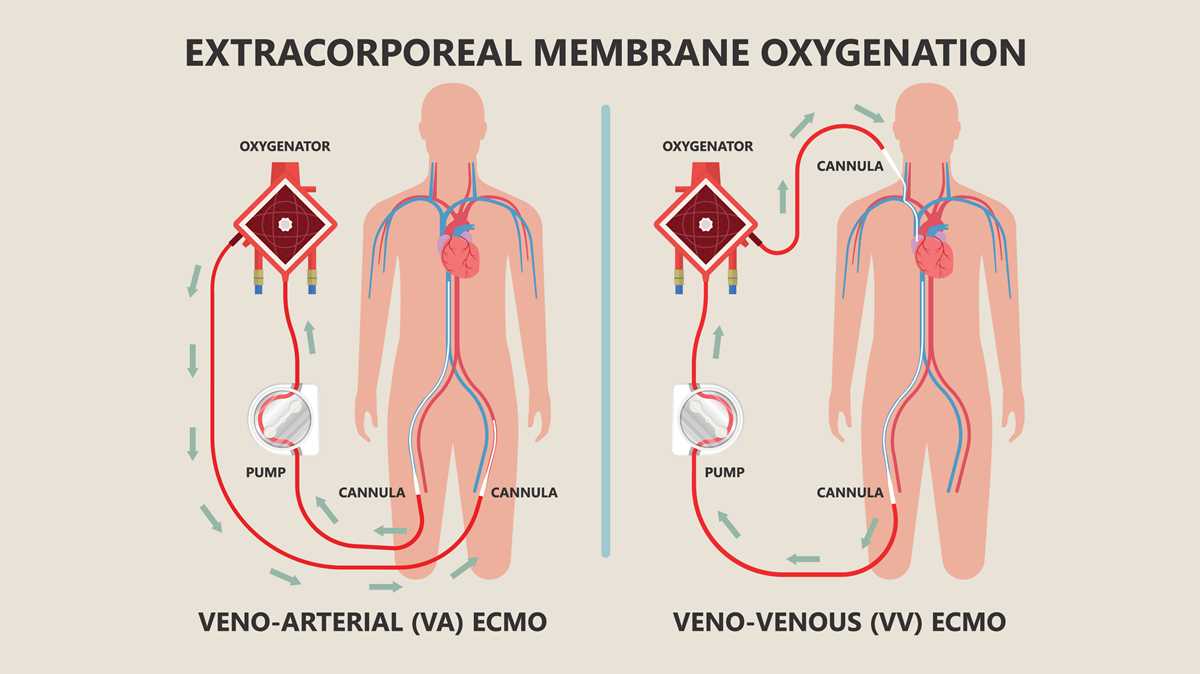 ecmo circuit diagram